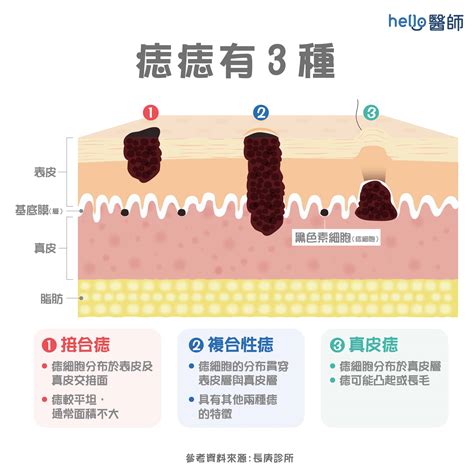 有毛的痣|痣形成的原因？痣長毛、痣變多變大是痣病變？5招判。